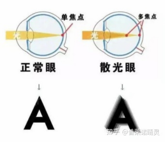 普莱诺睛灵：散光到底是什么？99%家长都不了解……