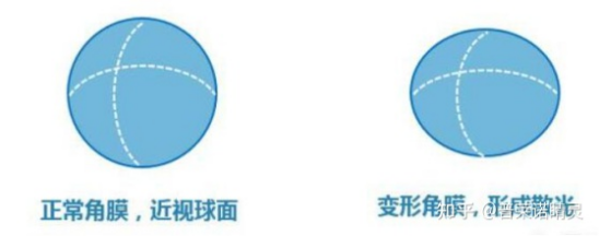 普莱诺睛灵：散光到底是什么？99%家长都不了解……