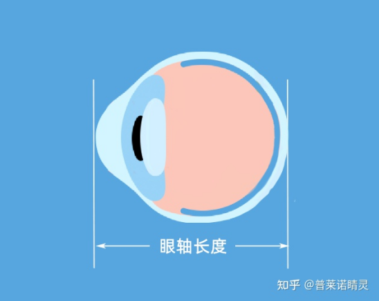 近视除了关注屈光度，还应关注眼轴！普莱诺睛灵3分钟教你读懂眼轴报告