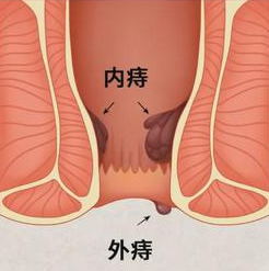 广东民安胃肠医院内痔外痔的发生是便便的黑不黑硬导致的吗