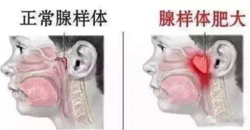 小孩鼾声频频？鼻腺宁：有可能是腺样体肥大