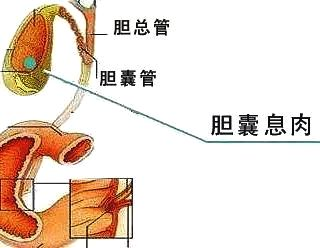 体检发现胆囊长了息肉，就只能是一切了之吗