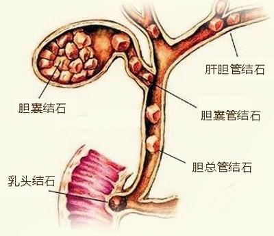 辨证治胆结石，李德昌主任谈中医特色及优势