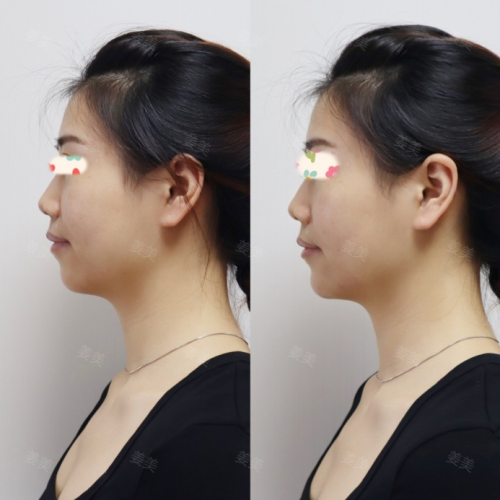 北京西美【注射塑型抗衰】姜美主任/医生：不同的脸型，好看的下巴应该怎么设计？