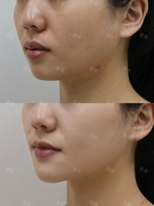 北京西美【注射塑型抗衰】姜美主任/医生：不同的脸型，好看的下巴应该怎么设计？