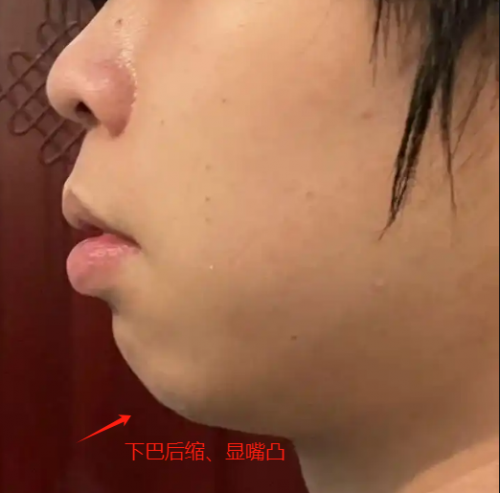 北京西美【注射塑型抗衰】姜美主任/医生：不同的脸型，好看的下巴应该怎么设计？