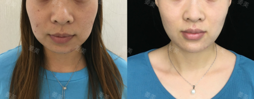 北京西美【注射塑型抗衰】姜美主任/医生：不同的脸型，好看的下巴应该怎么设计？