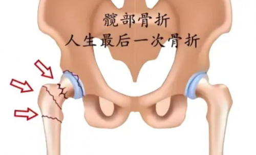 黑龙江中德骨科医院——高龄老人髋部骨折不是手术禁区，了解人工髋关节置换术