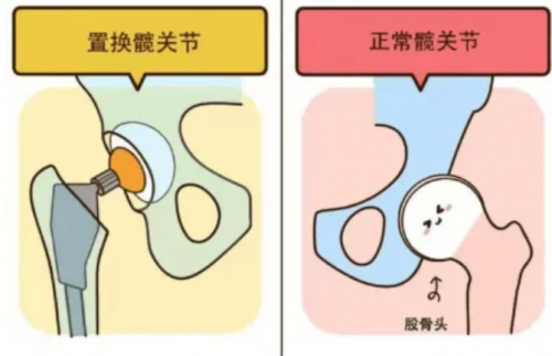 黑龙江中德骨科医院——高龄老人髋部骨折不是手术禁区，了解人工髋关节置换术
