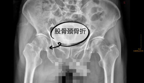黑龙江中德骨科医院——高龄老人髋部骨折不是手术禁区，了解人工髋关节置换术