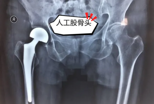 黑龙江中德骨科医院——高龄老人髋部骨折不是手术禁区，了解人工髋关节置换术