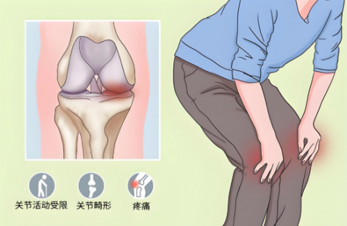 黑龙江中德骨科医院——单髁置换术为膝关节病患者带来崭新生活