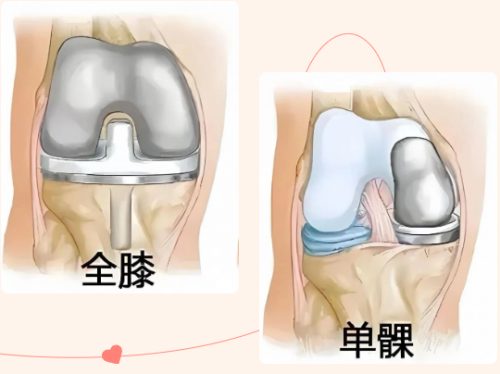 黑龙江中德骨科医院——单髁置换术为膝关节病患者带来崭新生活