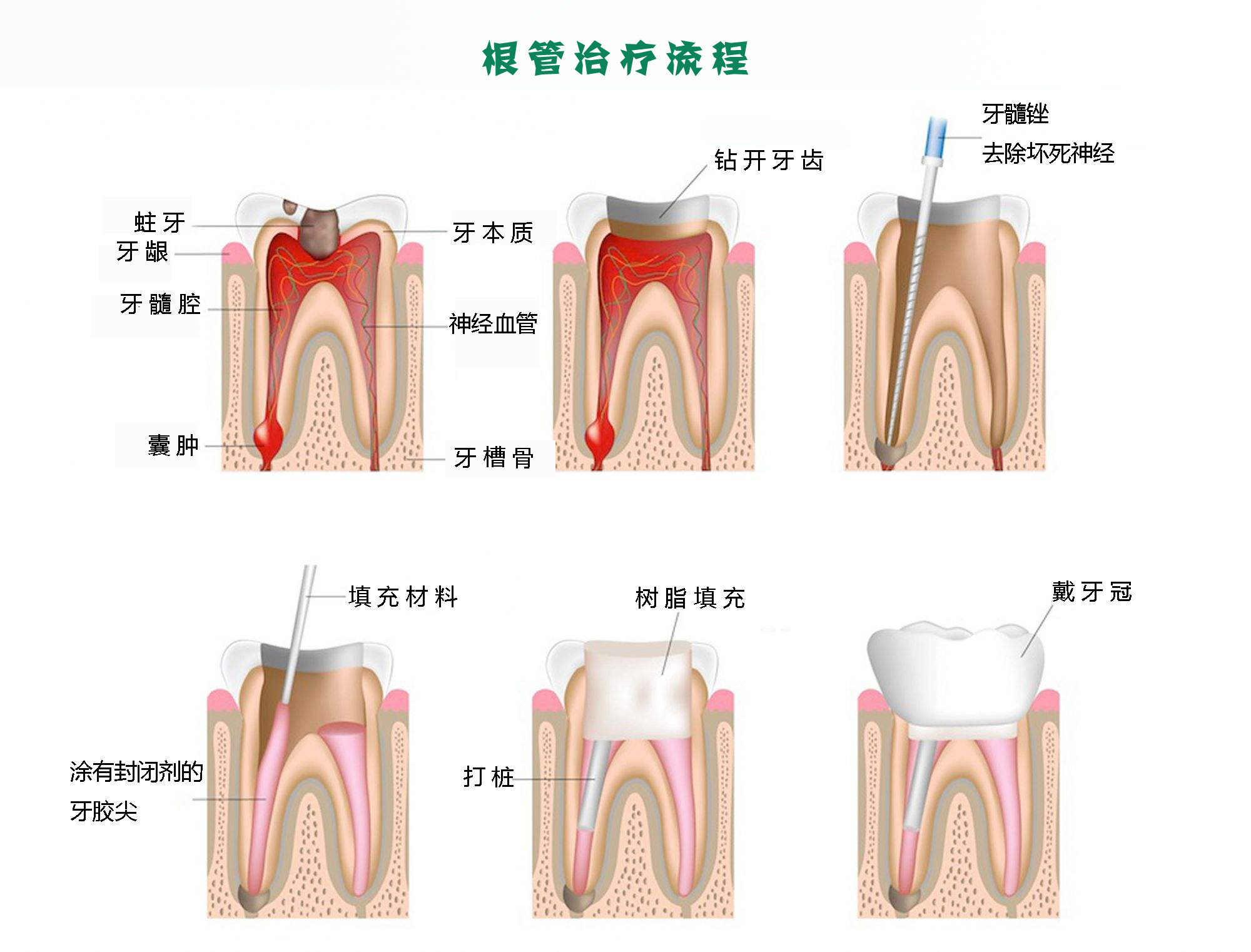 别再害怕做根管治疗！【天津海德堡联合口腔】专家【曹申】，带你了解根管治疗，从此不再害怕牙痛！