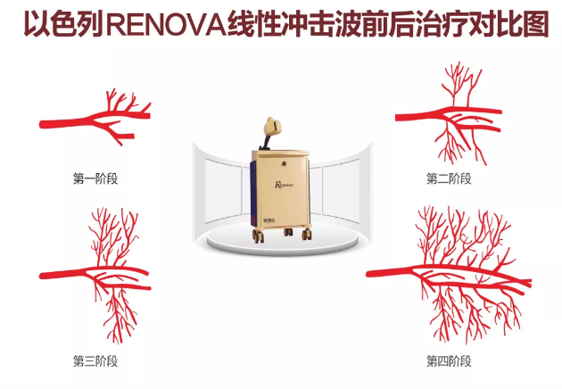 杭州阿波罗医院引进勃起功能障碍诊疗“黄金搭档”