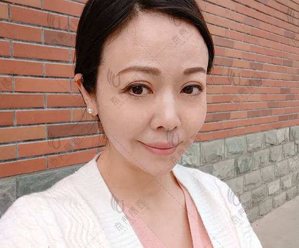 不开刀去眼袋到底有没有效果？