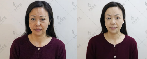 真实案例:43岁京典丽园不开刀祛眼袋效果 真实案例:43岁京典丽园不开刀祛眼袋效果