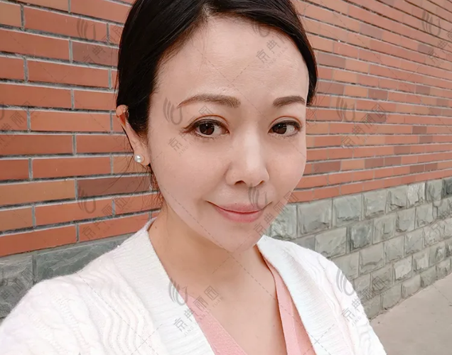 真实案例:43岁京典丽园不开刀祛眼袋效果 真实案例:43岁京典丽园不开刀祛眼袋效果