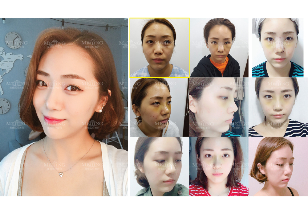 假体隆鼻安全吗？30年鼻整形临床经验北京美憬韩国院长李炳浍亲诊