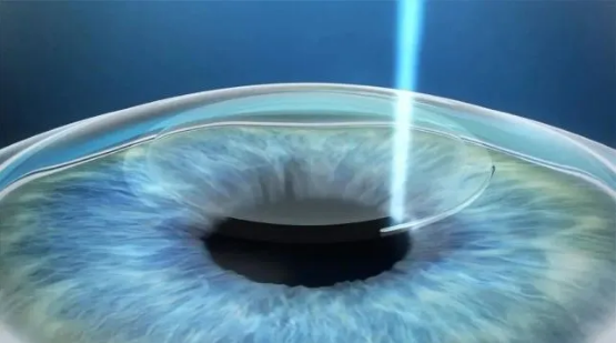 北京熙仁眼科医院【全飞秒活动】到底该做哪种近视手术？争取更好的未来！
