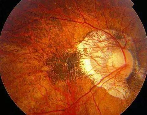 儿童近视眼镜如何选？了解近视成因，科学选择镜片