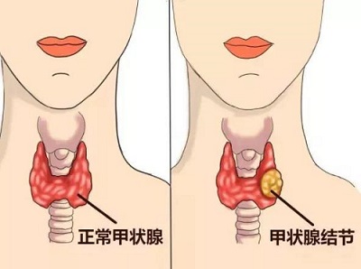 武汉民生耳鼻喉医院治疗甲状腺更专业诊断方便快捷治疗方法齐全