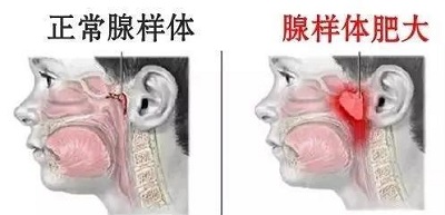 甲状腺结节怎么治疗方法是什么好武汉民生耳鼻喉医院在线咨询预约