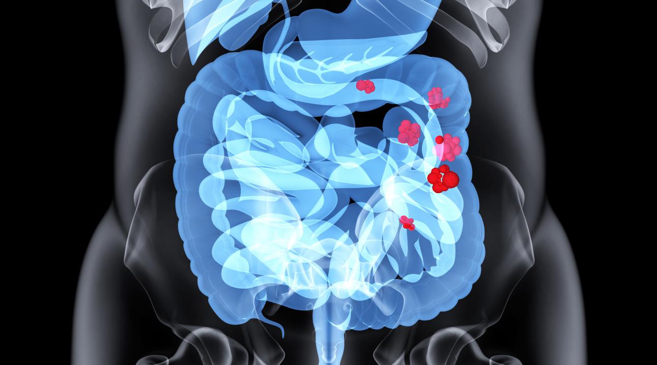 摄图网_401718845_肠道疾病场景（非企业商用）