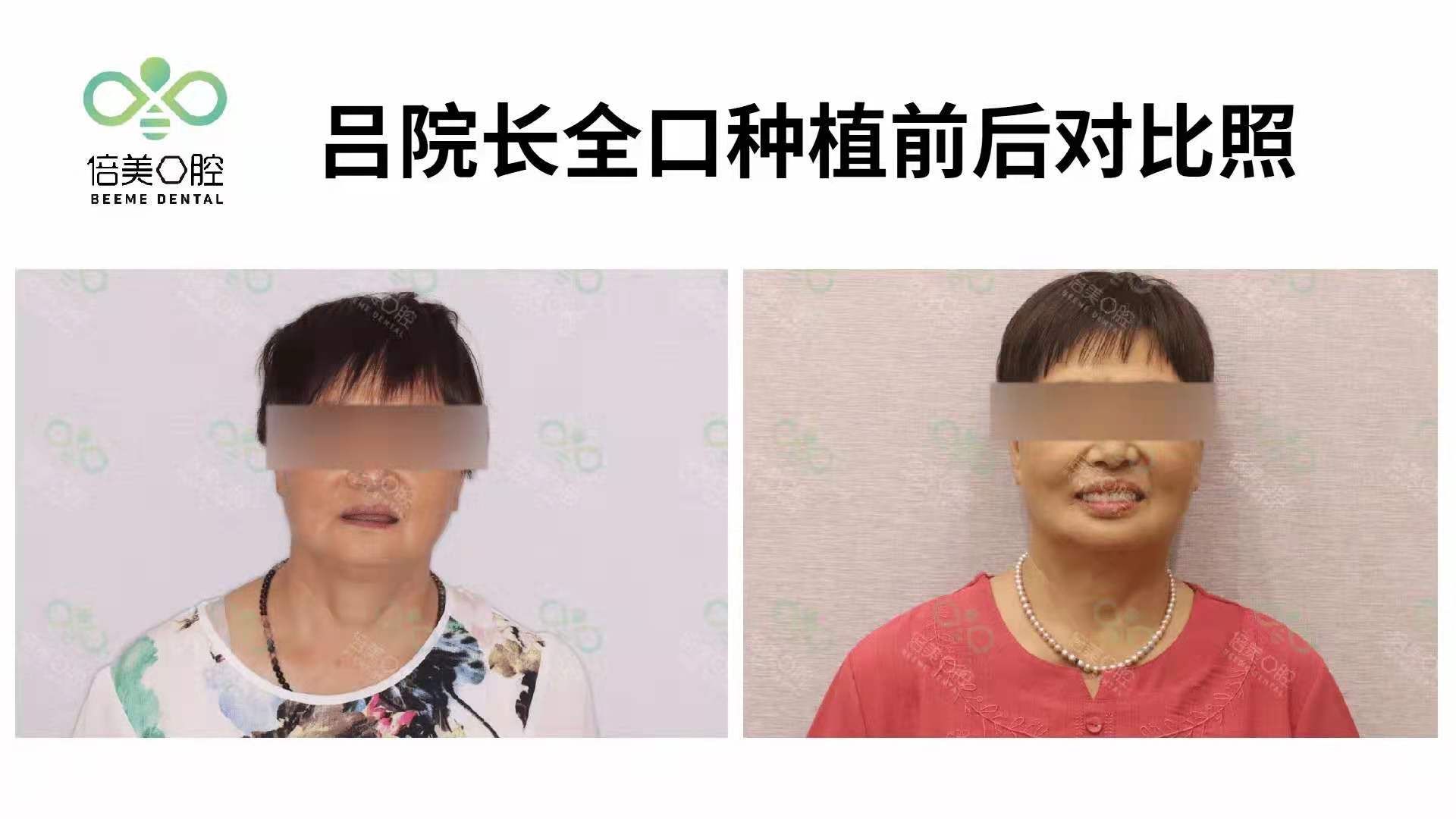 倍美口腔：老年人到底要不要做种植牙？李阿姨的种牙体验来了