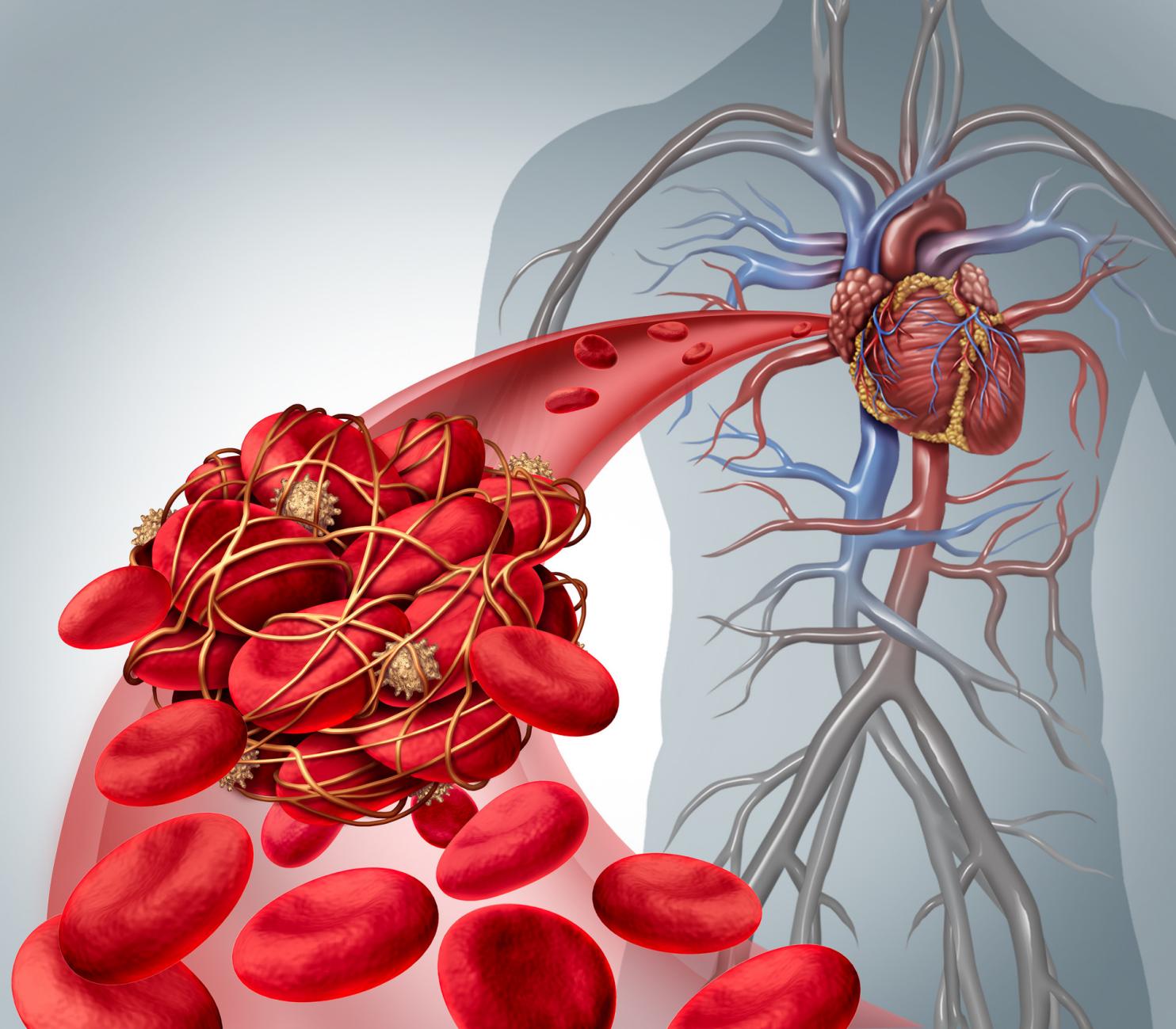摄图网_300849498_banner_血块风险血块血栓医学插图符号,人类血细胞聚集,由粘稠的血小板纤维蛋白造成动脉静脉阻塞,导致心脏（非企业商用）