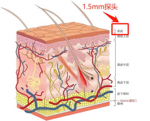 秦皇岛巧致整形：7D聚拉提不是智商税?