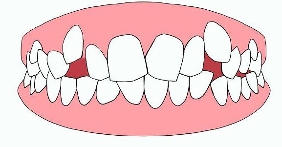沧州口腔牙齿矫正专家 莱恩口腔专家呼吁 牙齿拥挤不要错过矫正最佳时间