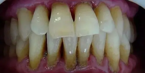 格伦菲尔刘君：牙齿矫正都要拔牙？正畸有哪些后遗症？