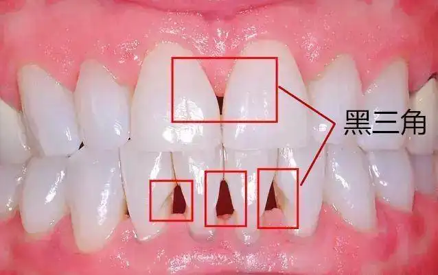 格伦菲尔刘君：牙齿矫正都要拔牙？正畸有哪些后遗症？