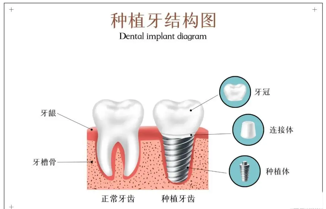 杜小润口腔医生：你想知道的种植牙知识都在这里了！