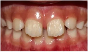 格伦菲尔口腔医生杨阳：孩子换牙的8大常见问题！90%家长都在找答案！