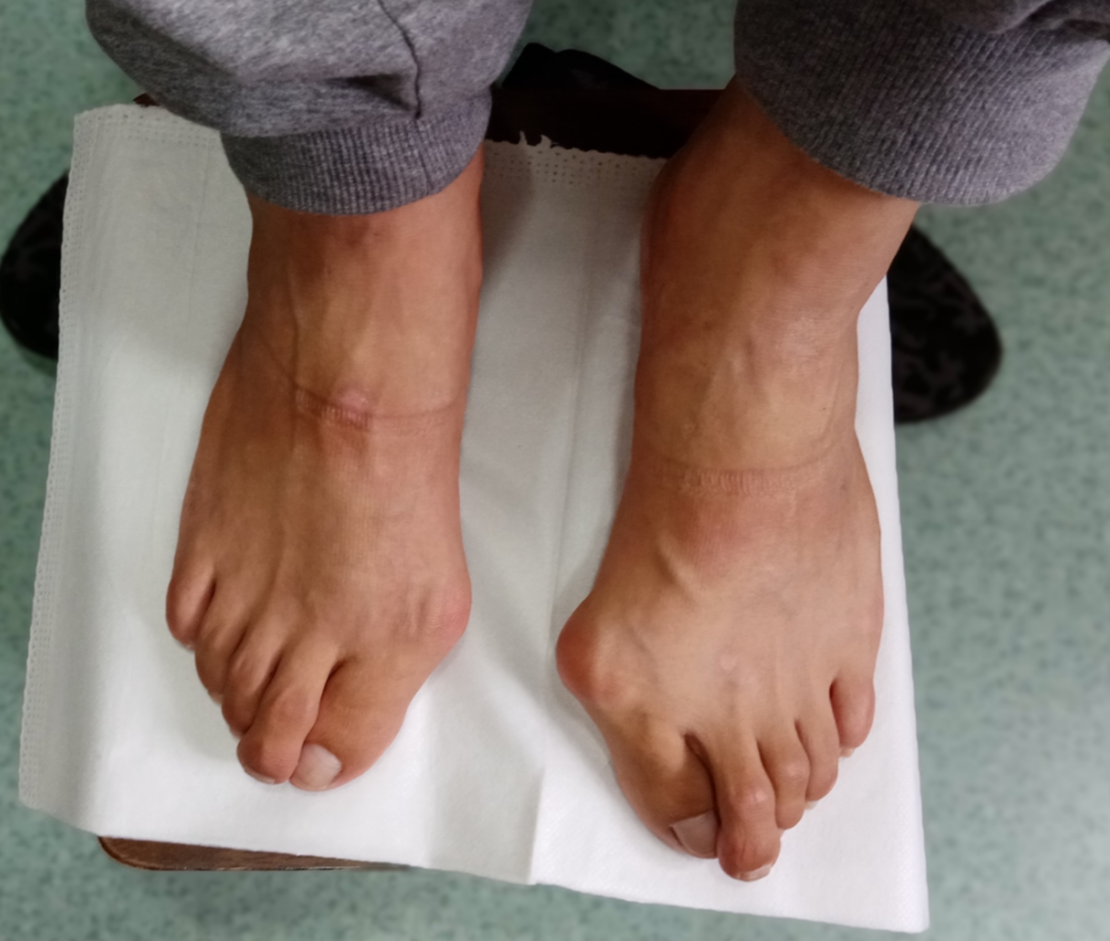 哪些原因会引起拇外翻? 哪些原因会引起拇外翻?