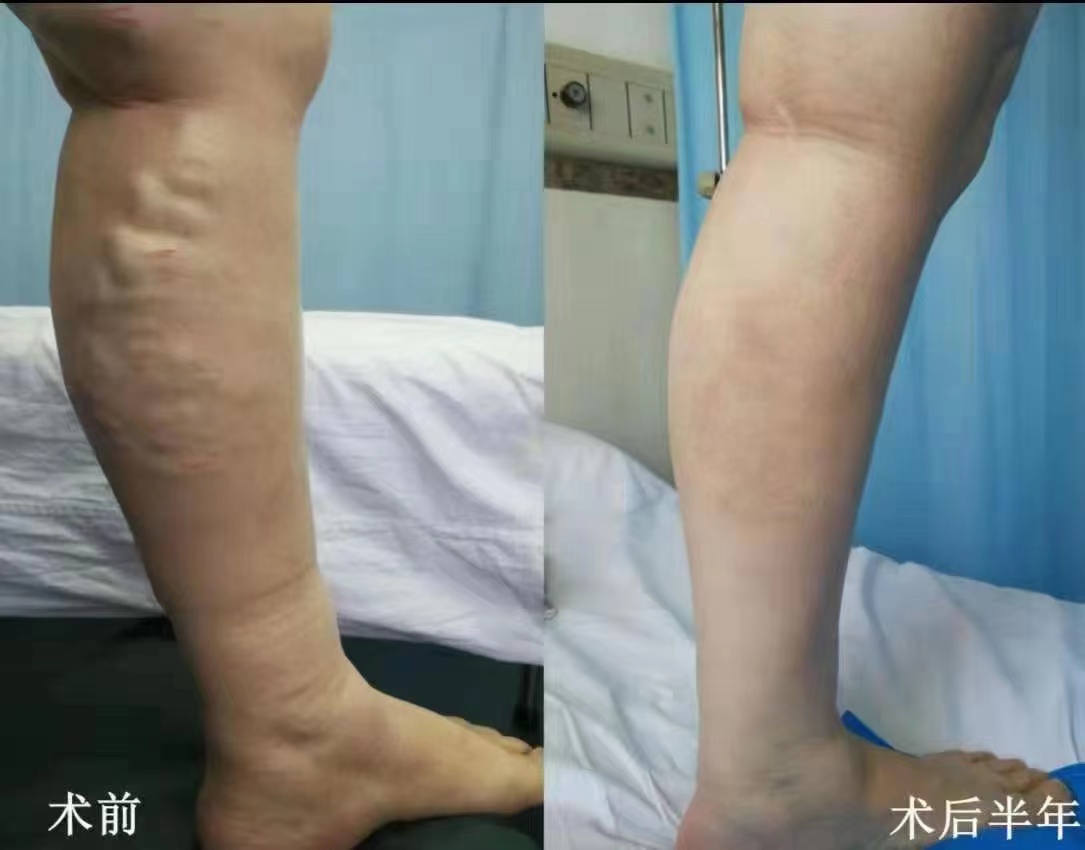 北京长峰医院CHIVA技术，轻松告别下肢静脉曲张