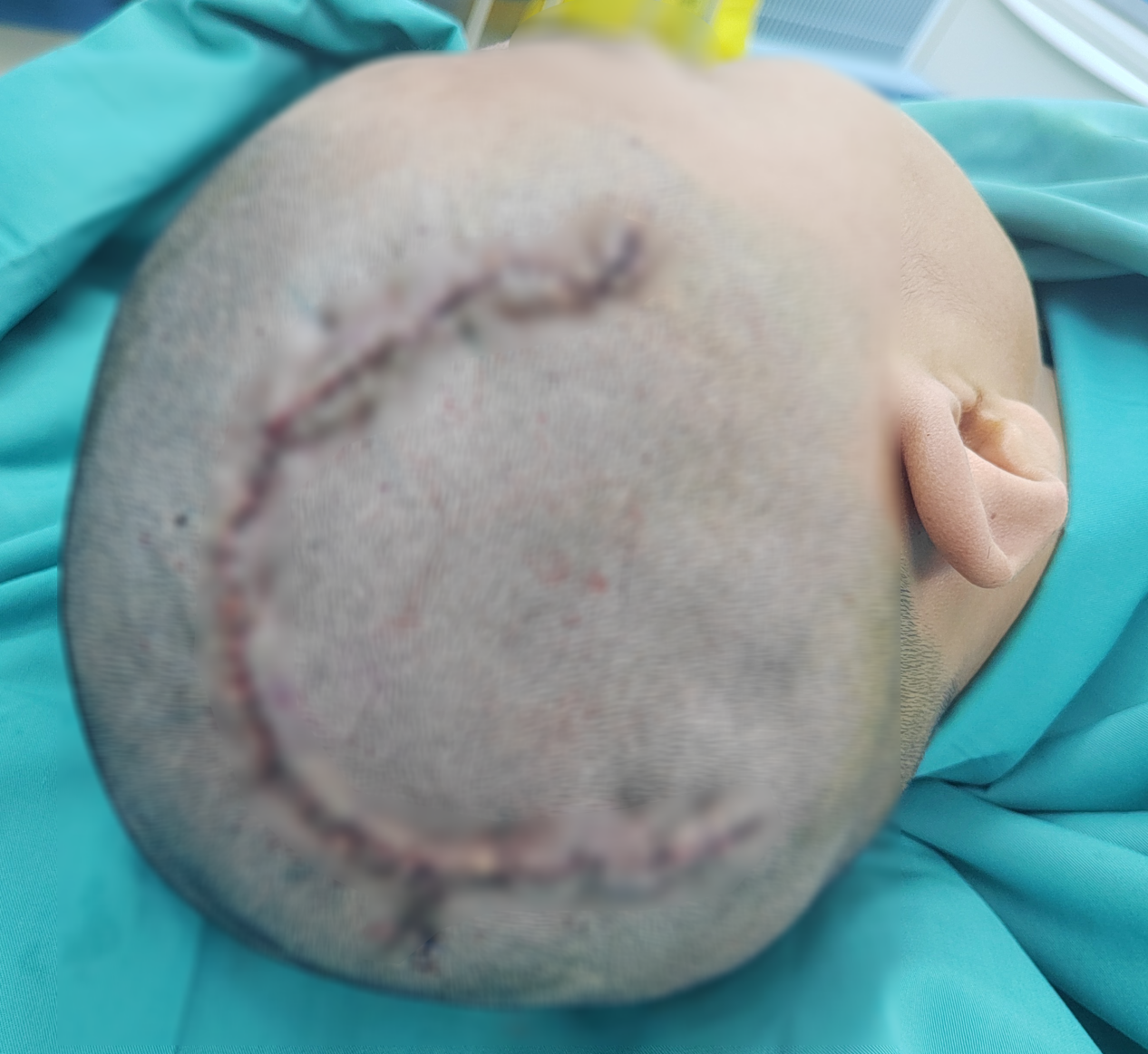 国际医学苏映军教授  修复12岁男童开颅术后14厘米“U”型疤痕