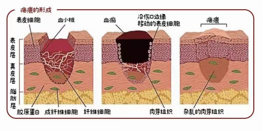 疤痕治疗重在早期干预，预防大于治疗