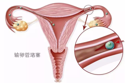 输卵管堵塞临床有哪些有效的治疗方法