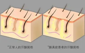 沈阳腋臭治疗就来肤康