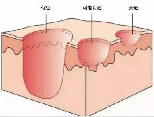 【沈阳肤康疤痕科普】凹陷疤痕是怎么形成的，该如何治疗？