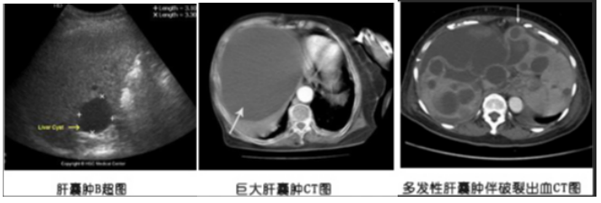 肝囊肿是什么原因引起的？上海太安医院中医科有治疗肝囊肿的专用药！