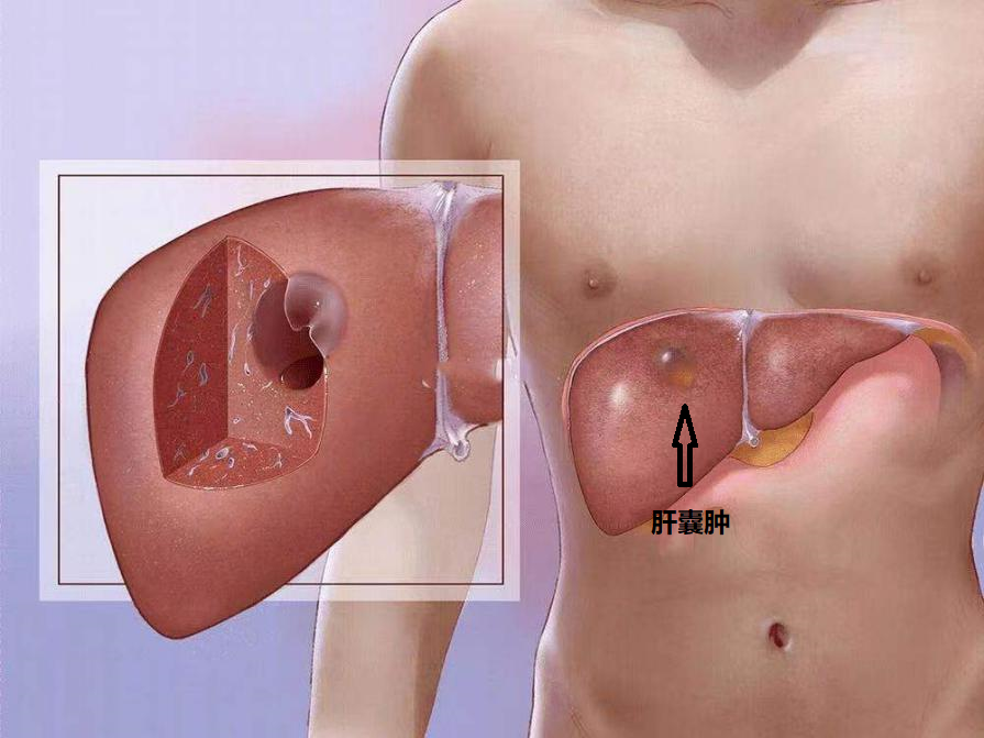 肝囊肿是什么原因引起的？上海太安医院中医科有治疗肝囊肿的专用药！