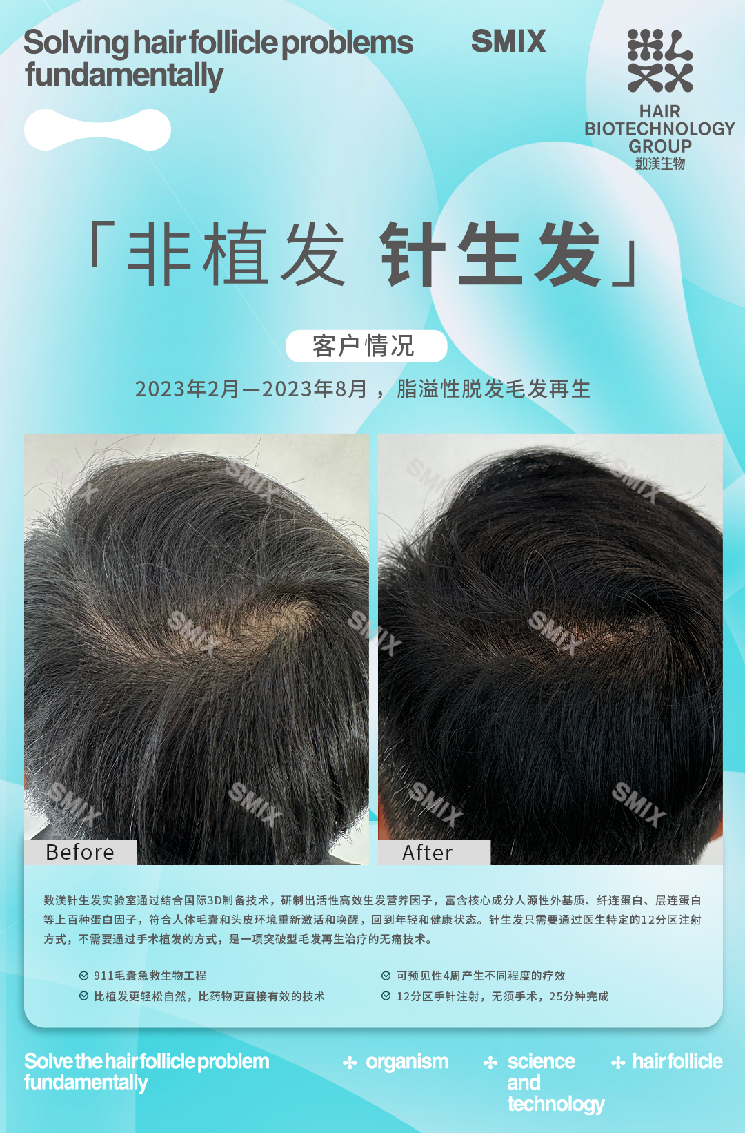 数渼生物针生发技术，3个月长头发！