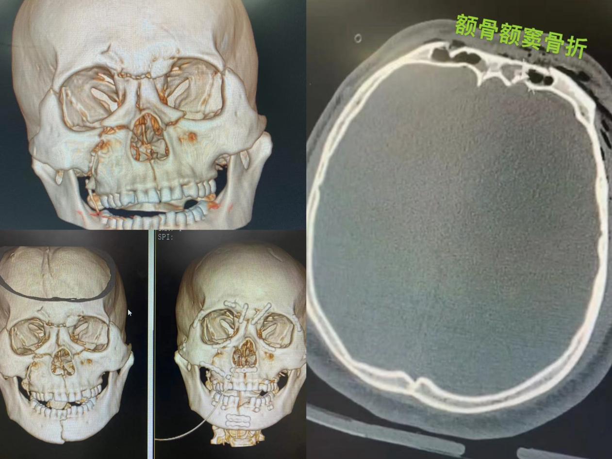 不给孩子戴头盔等于“坑娃” 车祸致眉骨三公分伤口