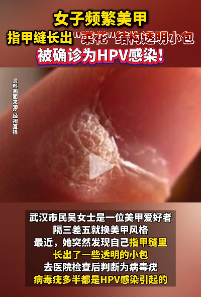 做美甲竟感染HPV？ 手指长出“菜花”型透明小包