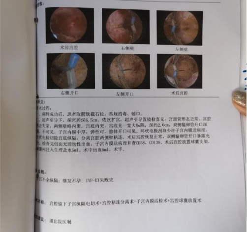 感恩能遇到这么优秀的宫腔镜专家治愈了我的纵隔子宫