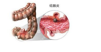 深圳天元中医肛肠医院:大便变细or不成型就查出了肠癌